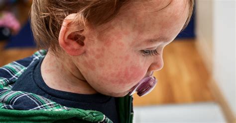 Allergic reaction in children